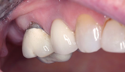 Crowns & Bridges - Before